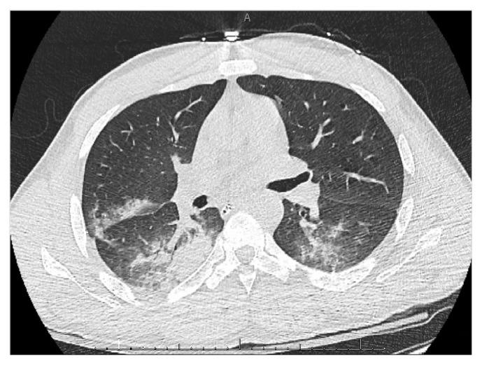 https://cdn.ncbi.nlm.nih.gov/pmc/blobs/db42/6545788/a4d193d45dbf/CRIPU2019-8137648.002.jpg