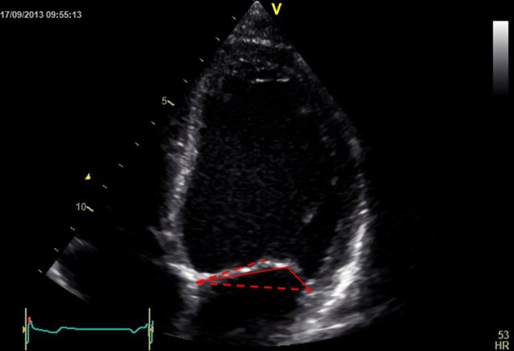 https://cdn.ncbi.nlm.nih.gov/pmc/blobs/db5d/4676476/c2b0765a4dc2/echo-02-R63-g013.jpg