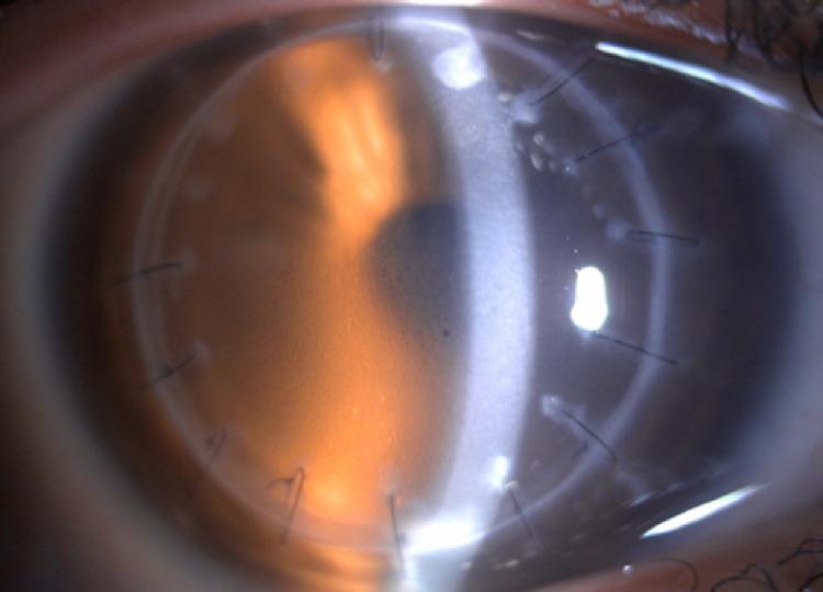 https://cdn.ncbi.nlm.nih.gov/pmc/blobs/dbe1/8139602/7ca072dff2c4/cureus-0013-00000014612-i03.jpg