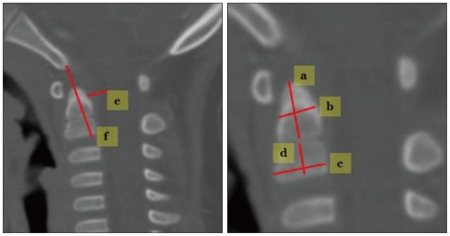 https://cdn.ncbi.nlm.nih.gov/pmc/blobs/dbea/4414772/aba327741b66/jkns-57-276-g003.jpg