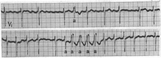 https://cdn.ncbi.nlm.nih.gov/pmc/blobs/dbf8/1017984/3822ad01f70f/brheartj00349-0081-a.jpg
