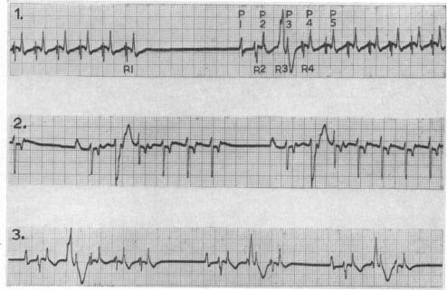 https://cdn.ncbi.nlm.nih.gov/pmc/blobs/dbf8/1017984/9bab80a4ca06/brheartj00349-0078-b.jpg