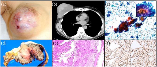 https://cdn.ncbi.nlm.nih.gov/pmc/blobs/dc7d/7278299/3047fac2faef/10.1177_2050313X20932005-fig1.jpg