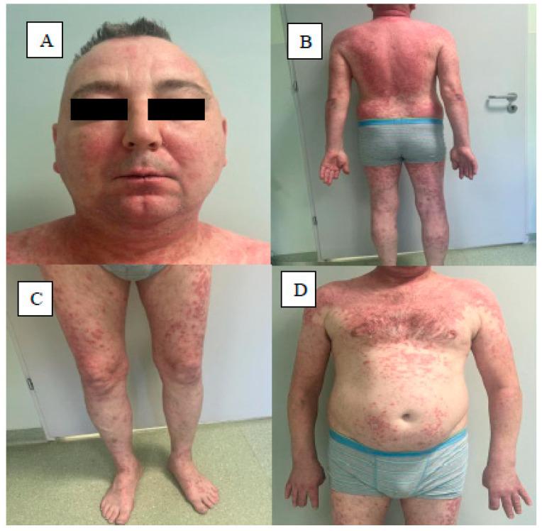 https://cdn.ncbi.nlm.nih.gov/pmc/blobs/dc8d/11312967/fa8a573730b6/jcm-13-04361-g004.jpg