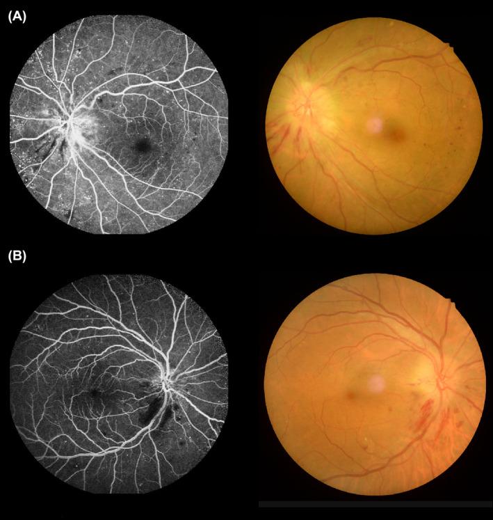 https://cdn.ncbi.nlm.nih.gov/pmc/blobs/dd03/10945884/e07fb04e73bb/CNS-30-e14579-g006.jpg