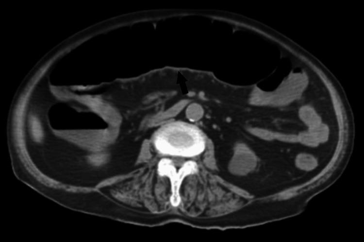 https://cdn.ncbi.nlm.nih.gov/pmc/blobs/dd08/10148746/eceecacddcaa/cureus-0015-00000036926-i02.jpg