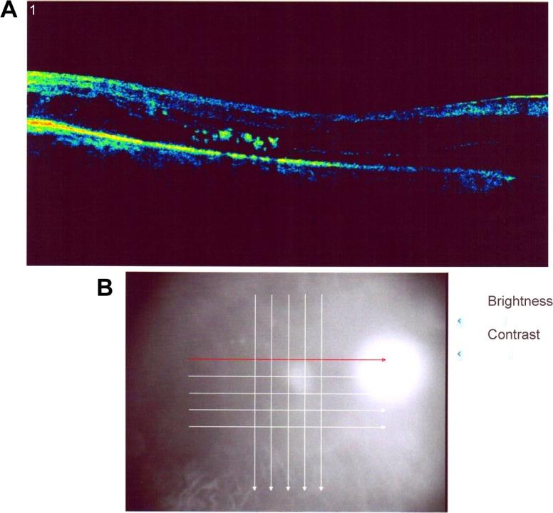 https://cdn.ncbi.nlm.nih.gov/pmc/blobs/ddd3/4860997/2e037cb287aa/opth-10-791Fig1.jpg