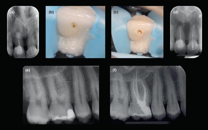 https://cdn.ncbi.nlm.nih.gov/pmc/blobs/de05/9796050/3c2634c033f6/IEJ-55-1059-g002.jpg