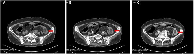 https://cdn.ncbi.nlm.nih.gov/pmc/blobs/de34/9280029/265b38c6f853/fsurg-09-915114-g002.jpg