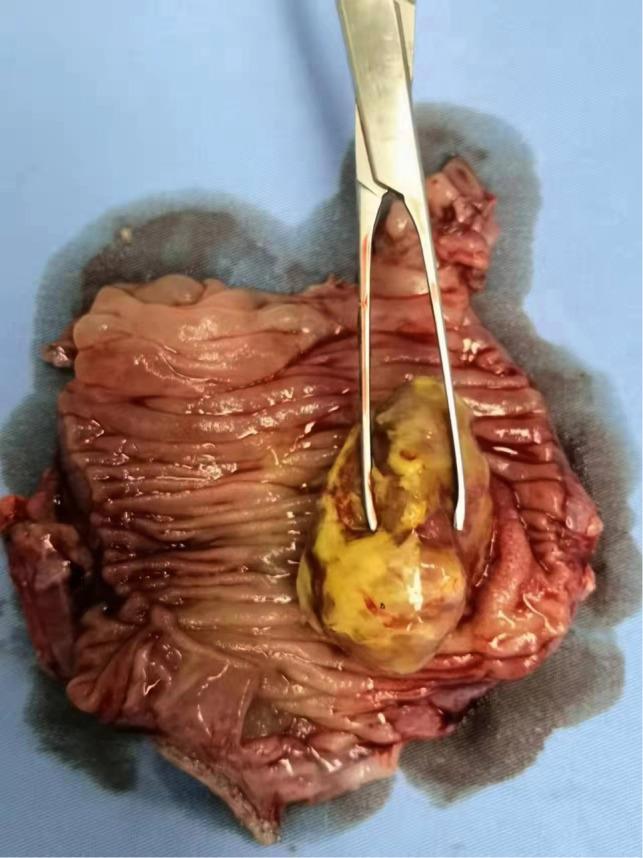 https://cdn.ncbi.nlm.nih.gov/pmc/blobs/de34/9280029/97e2c4d76667/fsurg-09-915114-g003.jpg