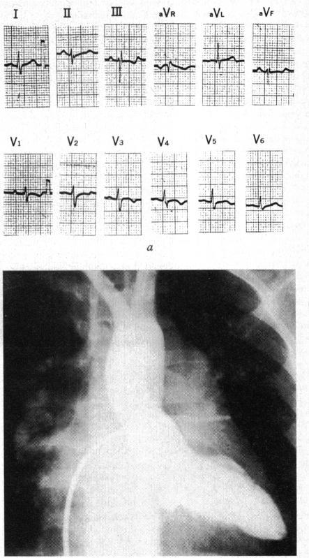https://cdn.ncbi.nlm.nih.gov/pmc/blobs/de5a/484103/089af0062ccd/brheartj00252-0107-a.jpg