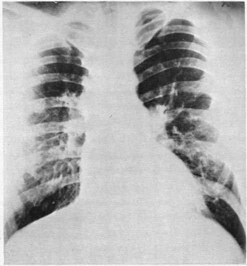 https://cdn.ncbi.nlm.nih.gov/pmc/blobs/de84/479636/726d650b8c99/brheartj00381-0044-b.jpg