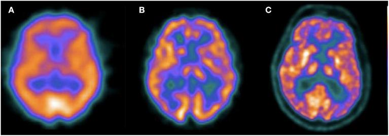 https://cdn.ncbi.nlm.nih.gov/pmc/blobs/ded8/8141564/f30ef66e45d8/fneur-12-629442-g0003.jpg