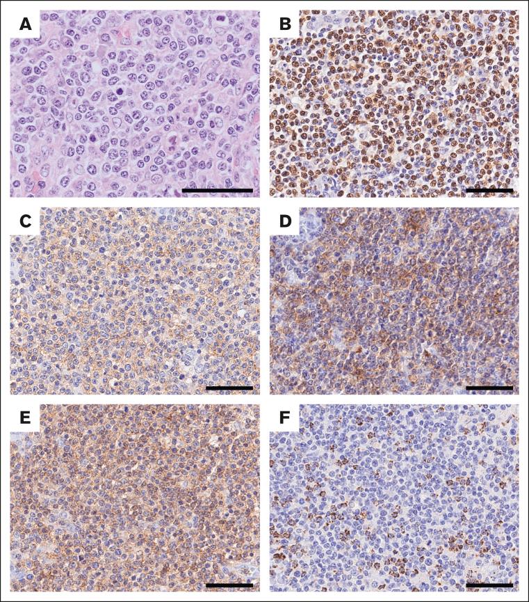 https://cdn.ncbi.nlm.nih.gov/pmc/blobs/df42/11068532/e301b4b8104c/BLOODA_ADV-2023-012019-gr3.jpg