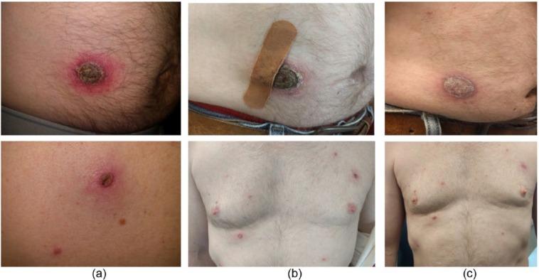 https://cdn.ncbi.nlm.nih.gov/pmc/blobs/df7e/5607913/fb4dced26860/10.1177_2050313X17731050-fig1.jpg