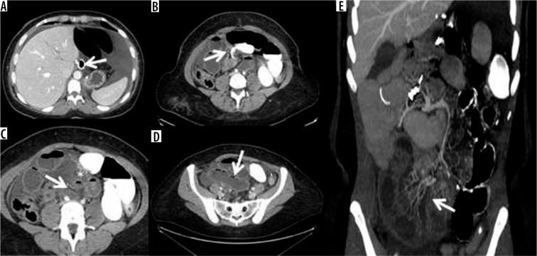 https://cdn.ncbi.nlm.nih.gov/pmc/blobs/dfcc/7976234/4b8f2b7c5e2a/PJR-86-43385-g011.jpg