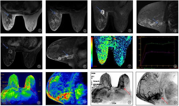 https://cdn.ncbi.nlm.nih.gov/pmc/blobs/e017/12380681/b69f0fffb705/fonc-15-1587243-g003.jpg