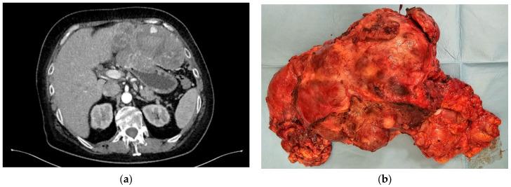 https://cdn.ncbi.nlm.nih.gov/pmc/blobs/e01c/11277334/e51ddc8fd60d/jcm-13-03997-g004.jpg