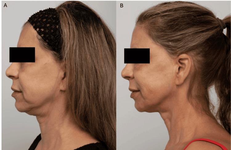 https://cdn.ncbi.nlm.nih.gov/pmc/blobs/e050/12344607/4d43848851ab/cureus-0017-00000087878-i01.jpg