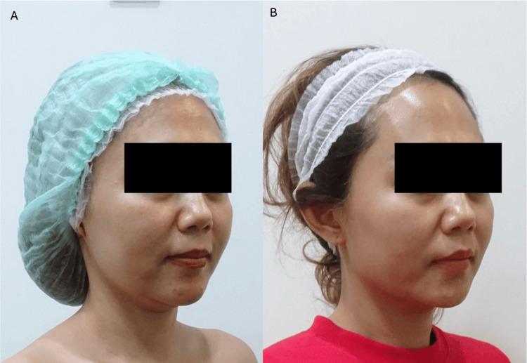 https://cdn.ncbi.nlm.nih.gov/pmc/blobs/e050/12344607/f62dc2e8b716/cureus-0017-00000087878-i03.jpg