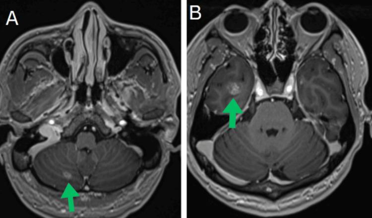 https://cdn.ncbi.nlm.nih.gov/pmc/blobs/e055/12350203/001ae389756c/cureus-0017-00000087943-i03.jpg