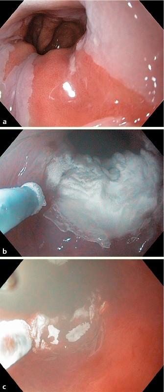 https://cdn.ncbi.nlm.nih.gov/pmc/blobs/e059/4477021/045f81475ffc/10-1055-s-0034-1390759-i114ei2.jpg