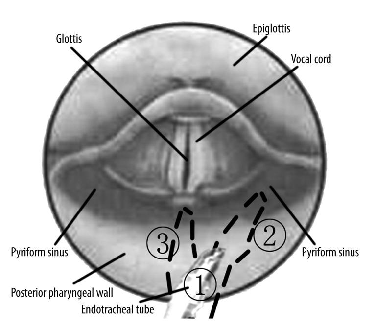 https://cdn.ncbi.nlm.nih.gov/pmc/blobs/e071/4186215/b274513fc8b6/medscimonit-20-1720-g004.jpg