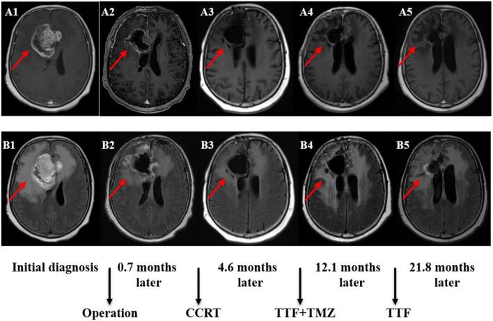https://cdn.ncbi.nlm.nih.gov/pmc/blobs/e07b/9869119/85910790e097/fneur-13-1042888-g0002.jpg