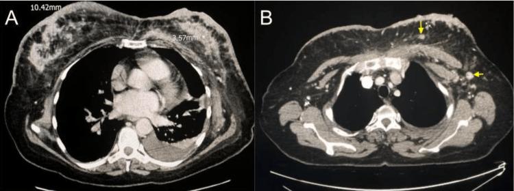 https://cdn.ncbi.nlm.nih.gov/pmc/blobs/e09a/9949754/11c89404e884/cureus-0015-00000034145-i02.jpg