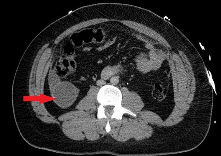 https://cdn.ncbi.nlm.nih.gov/pmc/blobs/e0d1/9273193/01ef9aa9efa7/cureus-0014-00000025832-i01.jpg