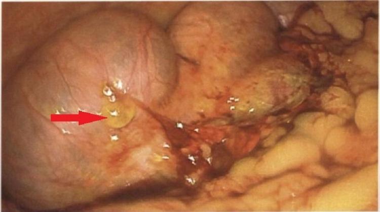 https://cdn.ncbi.nlm.nih.gov/pmc/blobs/e0d1/9273193/12bd8be0ba46/cureus-0014-00000025832-i02.jpg