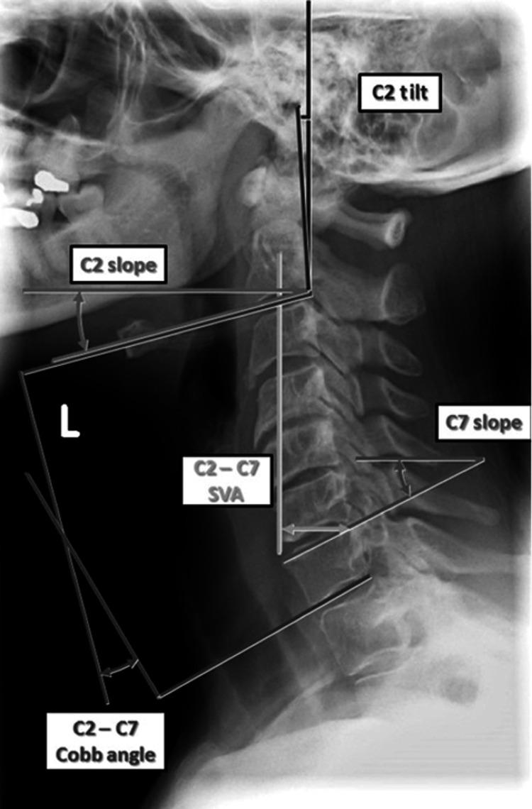 https://cdn.ncbi.nlm.nih.gov/pmc/blobs/e0da/12005606/37eb0269baff/cureus-0017-00000080777-i01.jpg