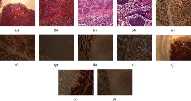https://cdn.ncbi.nlm.nih.gov/pmc/blobs/e162/7591277/12d8cce786bd/CRIONM2020-8819392.003.jpg