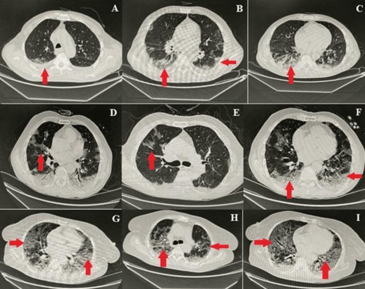 https://cdn.ncbi.nlm.nih.gov/pmc/blobs/e165/11995811/46fb8dc2ee2b/cureus-0017-00000080611-i01.jpg