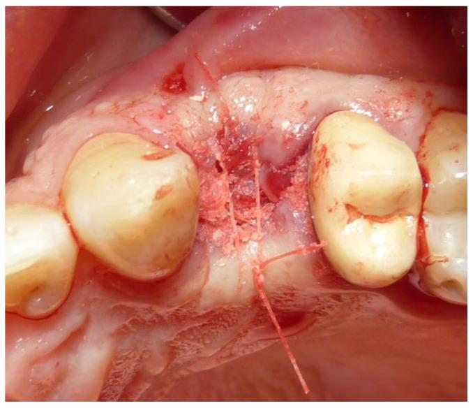 https://cdn.ncbi.nlm.nih.gov/pmc/blobs/e193/11505686/1c10b41120cb/dentistry-12-00320-g004.jpg