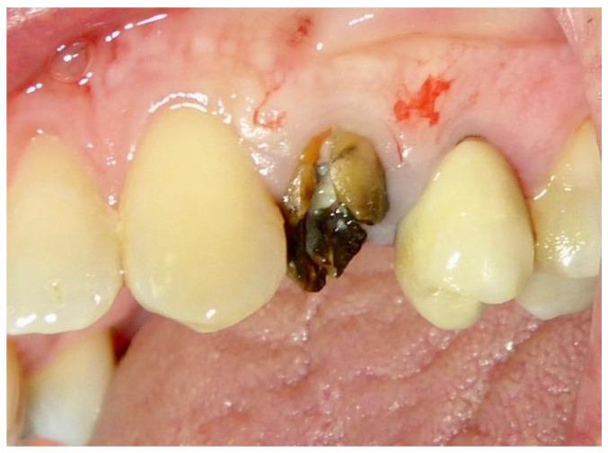 https://cdn.ncbi.nlm.nih.gov/pmc/blobs/e193/11505686/6658b9bd8e11/dentistry-12-00320-g001.jpg