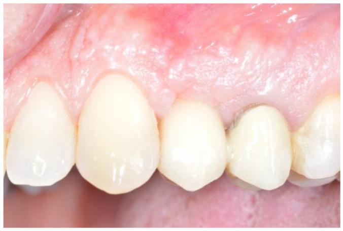https://cdn.ncbi.nlm.nih.gov/pmc/blobs/e193/11505686/70179c8c5965/dentistry-12-00320-g007.jpg