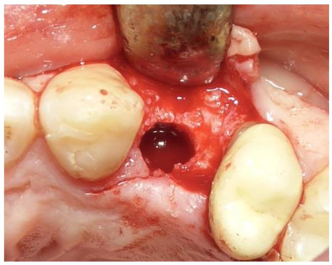 https://cdn.ncbi.nlm.nih.gov/pmc/blobs/e193/11505686/9a41e0282a64/dentistry-12-00320-g003.jpg