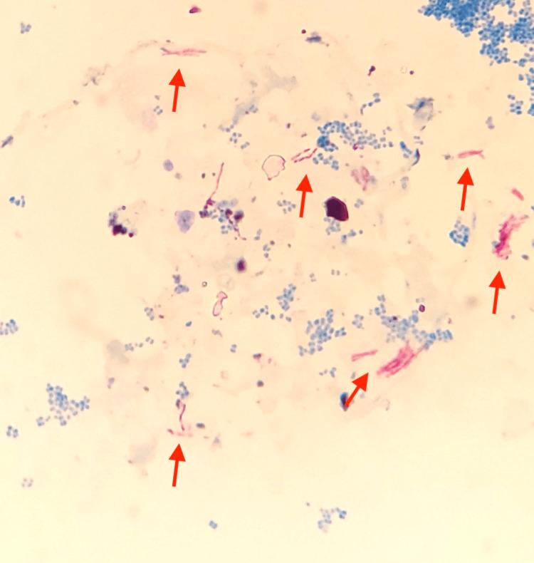 https://cdn.ncbi.nlm.nih.gov/pmc/blobs/e1b4/11753582/edfe460e7d04/cureus-0016-00000076263-i02.jpg