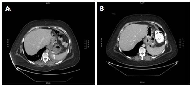 https://cdn.ncbi.nlm.nih.gov/pmc/blobs/e1c1/5355758/a13c12272050/WJGE-9-105-g006.jpg