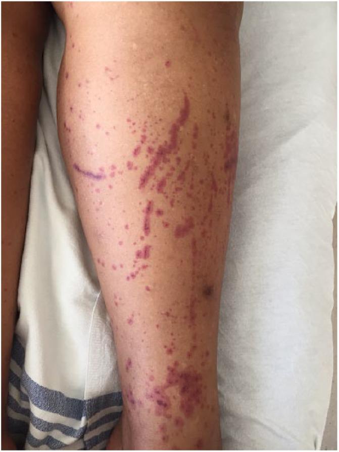 https://cdn.ncbi.nlm.nih.gov/pmc/blobs/e1c1/6537234/21d5735dc648/10.1177_2050313X19850353-fig1.jpg