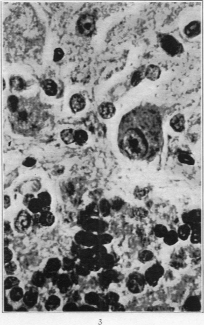 https://cdn.ncbi.nlm.nih.gov/pmc/blobs/e206/2062682/6b3f10e0c634/amjpathol00722-0061-c.jpg