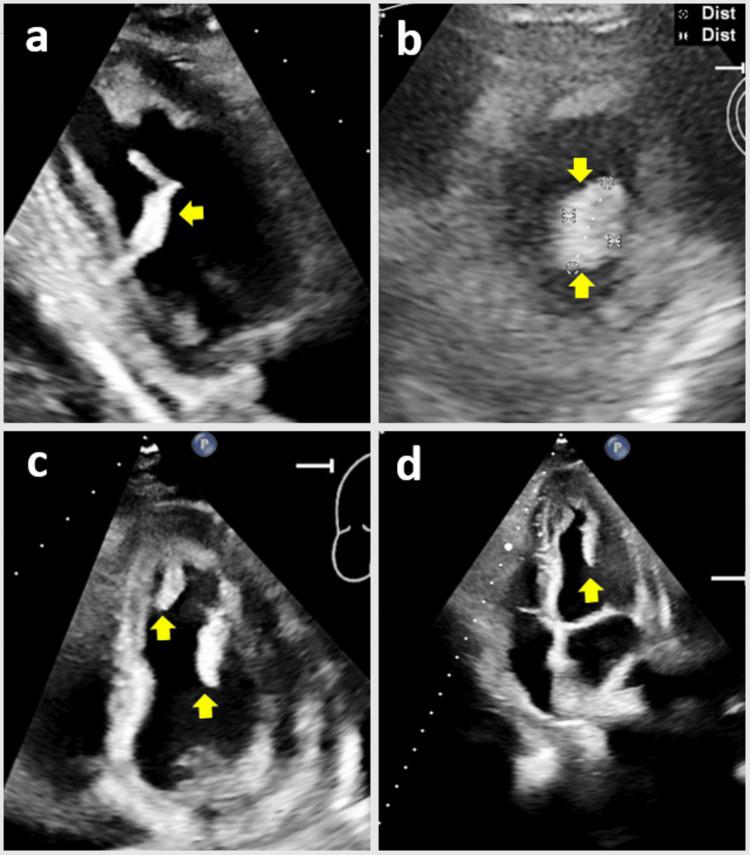 https://cdn.ncbi.nlm.nih.gov/pmc/blobs/e2c4/11223752/b825f7f42b8a/cureus-0016-00000061674-i01.jpg