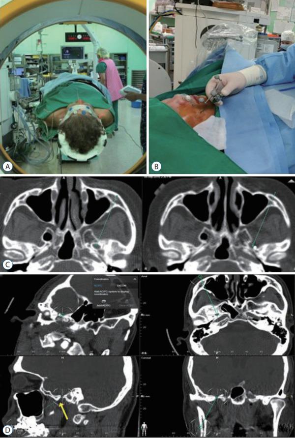 https://cdn.ncbi.nlm.nih.gov/pmc/blobs/e2f6/9452389/33ebffdee190/jkns-2022-0074f3.jpg