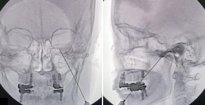 https://cdn.ncbi.nlm.nih.gov/pmc/blobs/e2f6/9452389/4e929672fef1/jkns-2022-0074f2.jpg