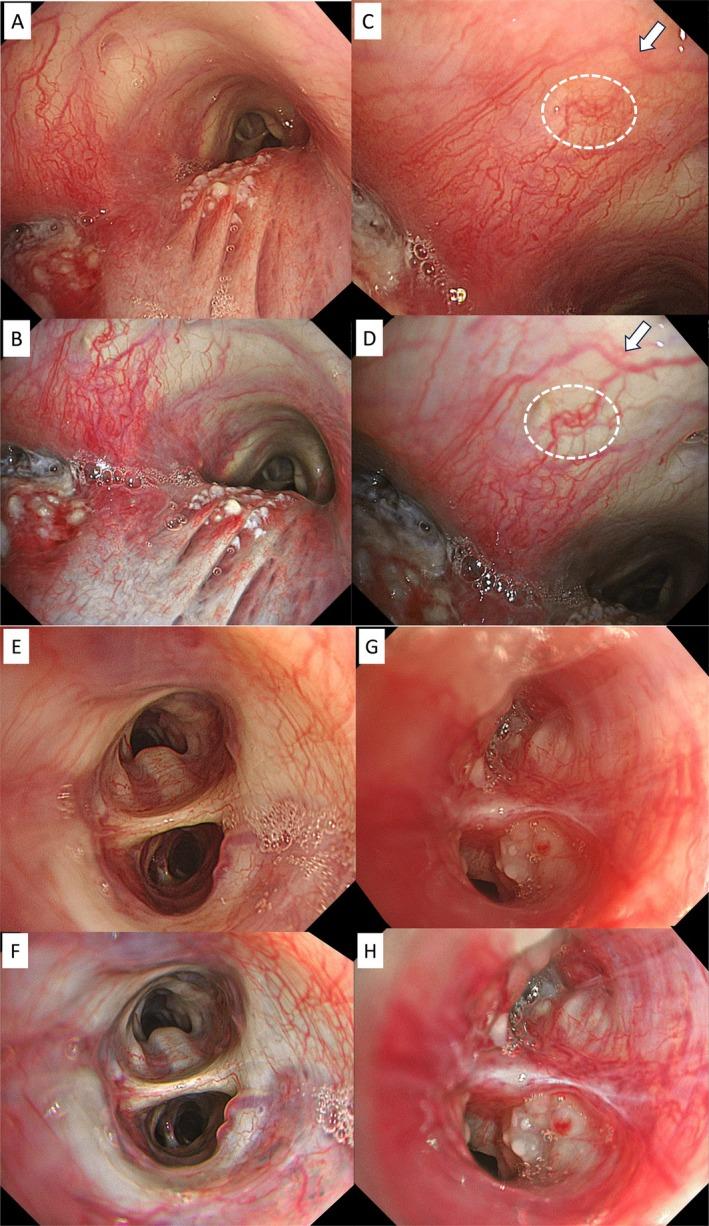 https://cdn.ncbi.nlm.nih.gov/pmc/blobs/e343/11986264/5e56c18fb49e/TCA-16-e70065-g003.jpg
