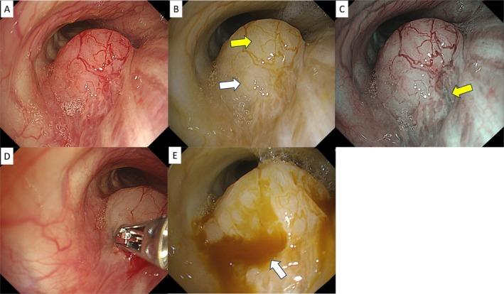 https://cdn.ncbi.nlm.nih.gov/pmc/blobs/e343/11986264/aafd6f2142ef/TCA-16-e70065-g001.jpg