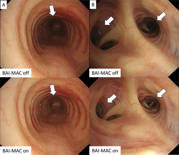 https://cdn.ncbi.nlm.nih.gov/pmc/blobs/e343/11986264/e2a5916643c8/TCA-16-e70065-g004.jpg