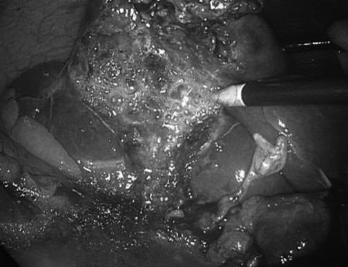 https://cdn.ncbi.nlm.nih.gov/pmc/blobs/e343/3015641/deeecf069dd9/jsls-9-4-478-g03.jpg