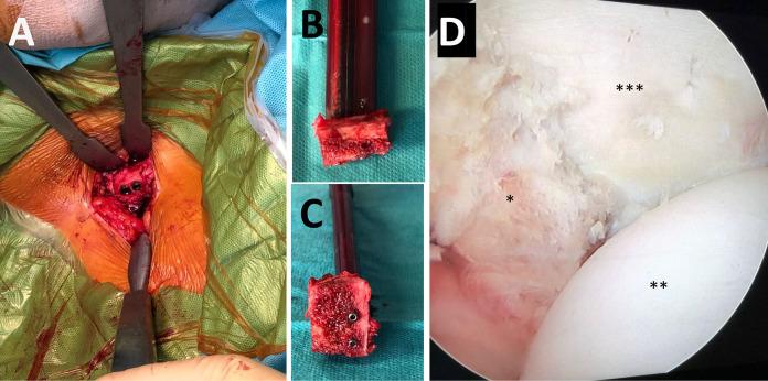 https://cdn.ncbi.nlm.nih.gov/pmc/blobs/e351/7844463/319879a328c4/10.1177_2325967120976378-fig2.jpg
